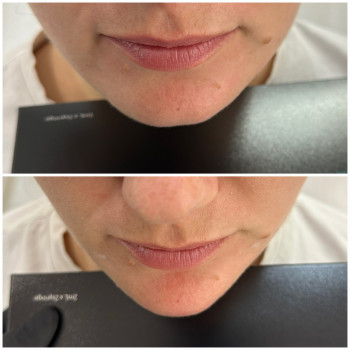 Контурна пластика обличчя