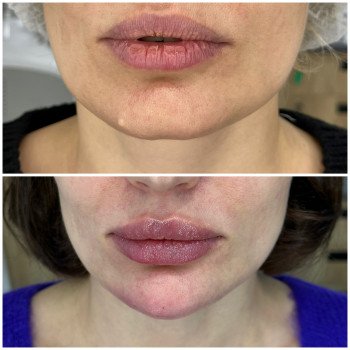 Контурна пластика обличчя