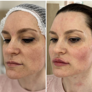 Контурна пластика обличчя