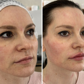 Контурна пластика обличчя