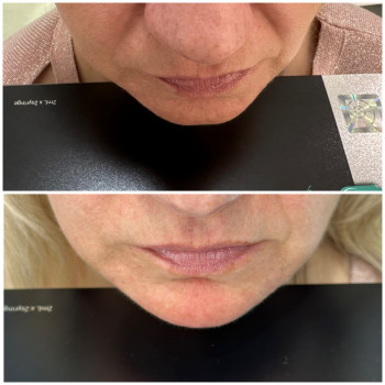 Контурна пластика обличчя