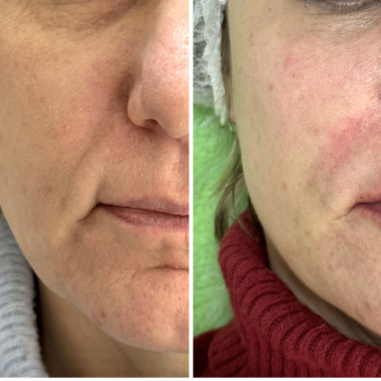 Контурна пластика обличчя