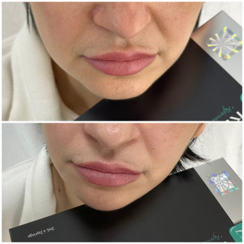 Контурна пластика обличчя