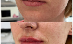 Контурна пластика губ Косметологический центр Dr. Galatska clinic Киев