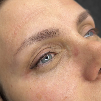 Стрілочки одразу після процедури ПМ