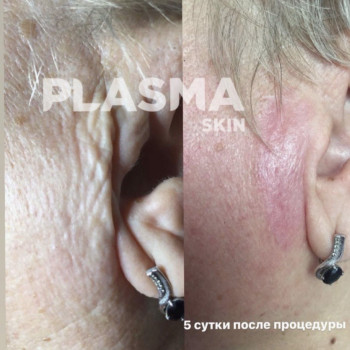 Видалення зморшок в зоні вух