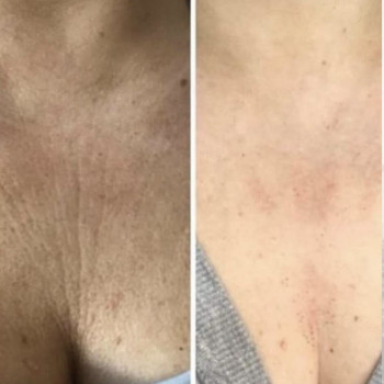 Видалення зморшок в зоні декольте