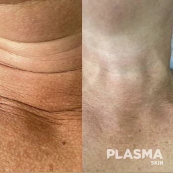 Видалення кілець Вкнери