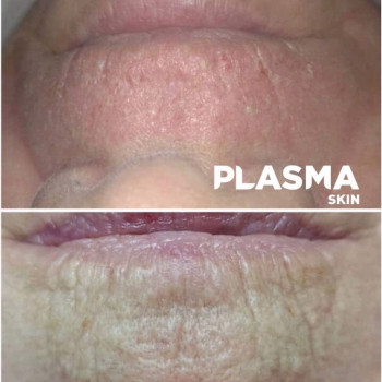 Видалення кисетних зморшок