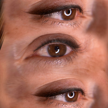   стрілочка  після процедури