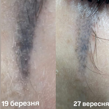 Зроблено два видалення ремувером