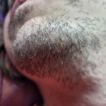 До першого проходу електроепіляцією