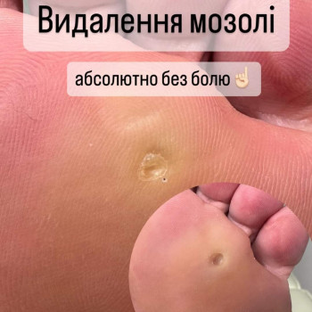  #удалениестержневыхмозолей
