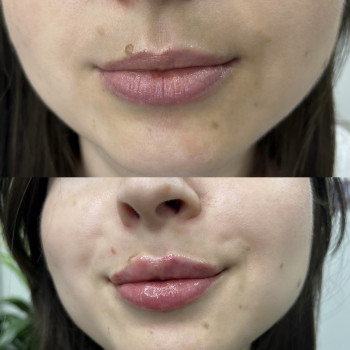 Контурна пластика губ
                    Врач-косметолог Ирина Краматорск