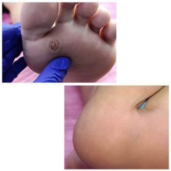 Видалення бородавок