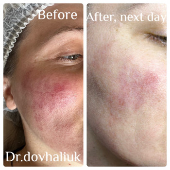 Апаратна косметологія обличчя догляд за обличчям, фото - косметологічний центр Клініка здоров'я та краси Поза часом