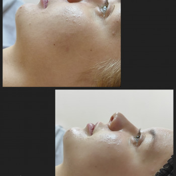 Механическая чистка