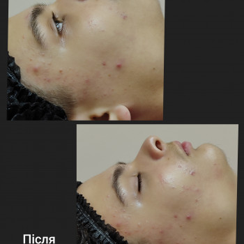 1 сеанс чистки