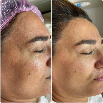 Пилинг 1 процедура