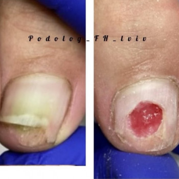 врослий ніготь, лікування нігтів на ногах, лікування стопи