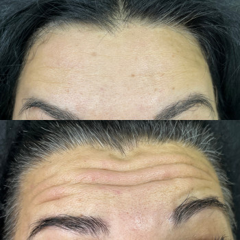 Ботокс
                    Врач-косметолог Ирина Краматорск