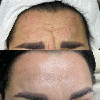 Ботокс
                    Врач-косметолог Ирина Краматорск