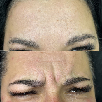 Ботокс
                    Врач-косметолог Ирина Краматорск