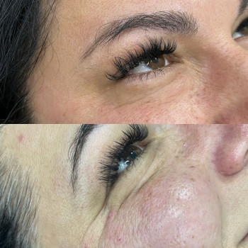 Ботокс
                    Врач-косметолог Ирина Краматорск