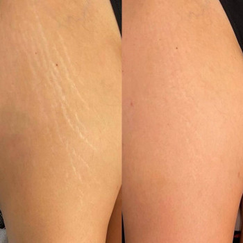 Лікування розтяжок, шрамів, рубців

 