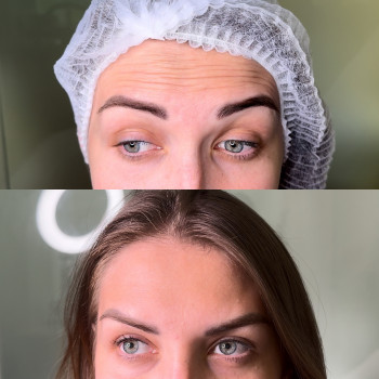 Ботулінотерапія