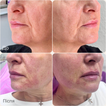 Контурна пластика нижня та середня третина обличчя