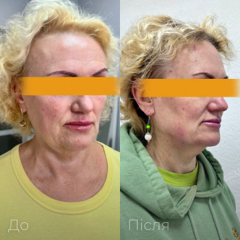 Контурна пластика нижня та середня третина обличчя