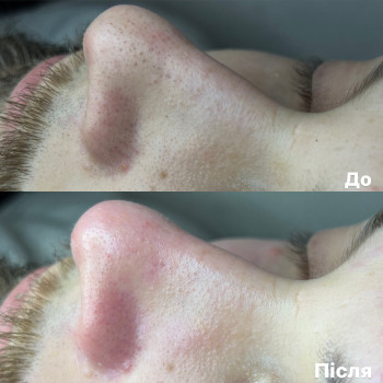 Чистка обличчя (комбінована)
                    Врач-косметолог Ксенія Ужгород