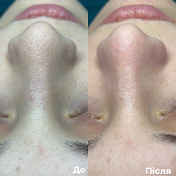 Чистка обличчя (комбінована)
                    Врач-косметолог Ксенія Ужгород