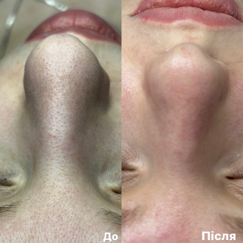 Чистка обличчя (комбінована)
                    Врач-косметолог Ксенія Ужгород