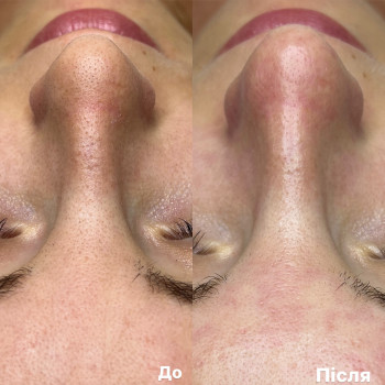 Чистка обличчя (комбінована)
                    Врач-косметолог Ксенія Ужгород