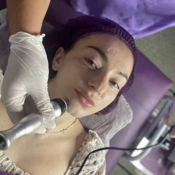 Безпосередньо виконання процедури rf - ліфтингу спеціальним аппаратом