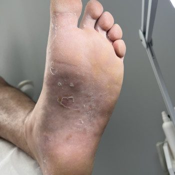 Обробка стопи , фото до , у пацієнта підозра на екзему