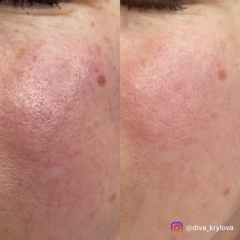 «Профілактика куперозу»
Купероз та пересушення шкіри викликають почервоніння, ламкість капілярів і...