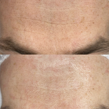 Ультразвукова чистка та мигдалевий пілінг 50% глибоко очищують пори, вирівнюють тон шкіри та стимулю...