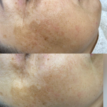 Пігментація — це зміна кольору шкіри, викликана впливом сонця, віковими змінами або гормональними по...