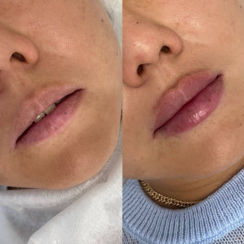 Збільшення губ
                    Косметолог Алина Киев