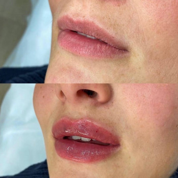 Збільшення губ
                    Косметолог Алина Киев