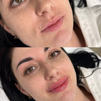 Збільшення губ
                    Косметолог Алина Киев