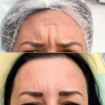 Ботокс
                    Косметолог Алина Київ