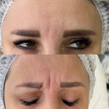 Ботокс
                    Косметолог Алина Київ