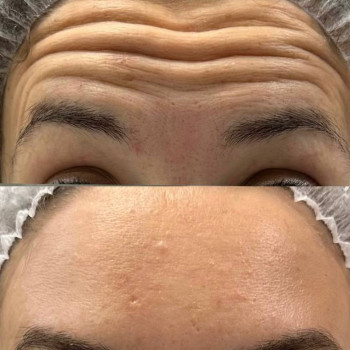 Ботокс
                    Косметолог Алина Київ