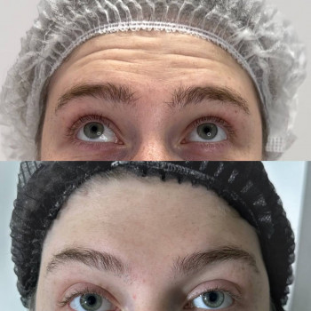 Ботокс
                    Косметолог Алина Київ