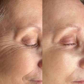 Ботокс
                    Косметолог Алина Київ