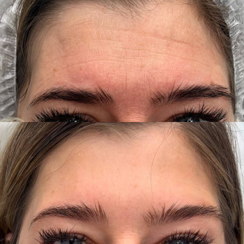 Ботокс
                    Косметолог Алина Київ